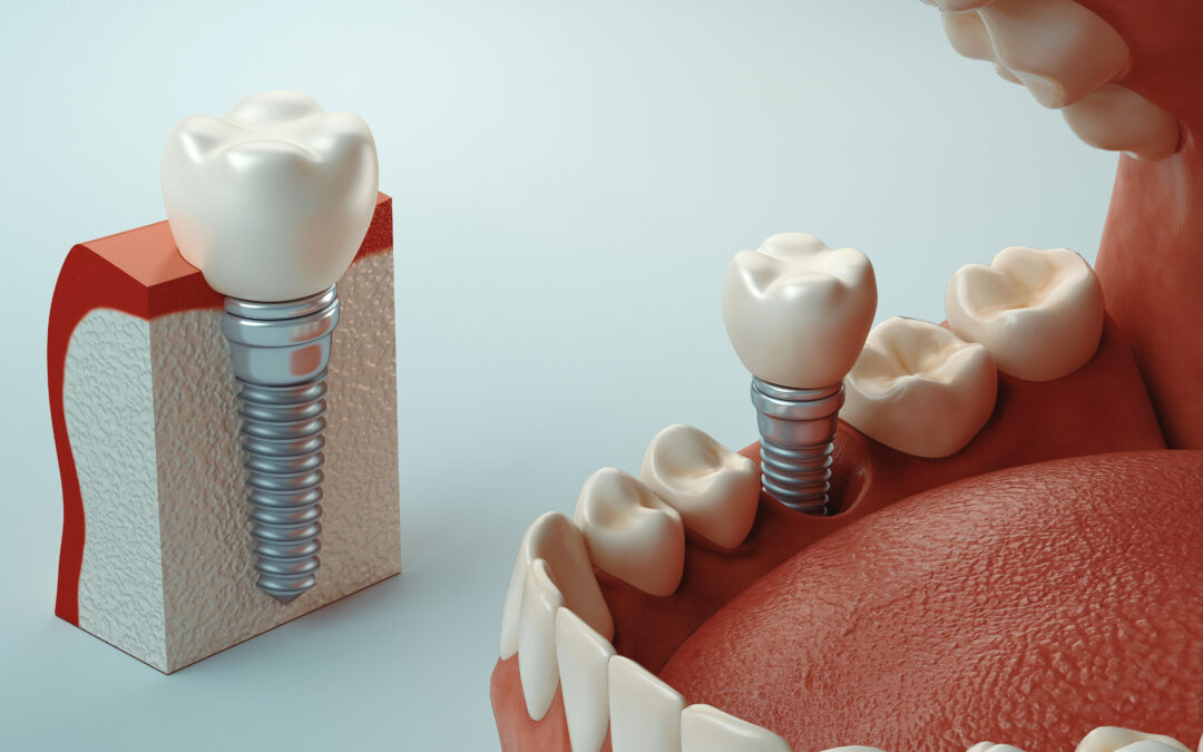 Can Cold Temperatures Affect Dental Implants?