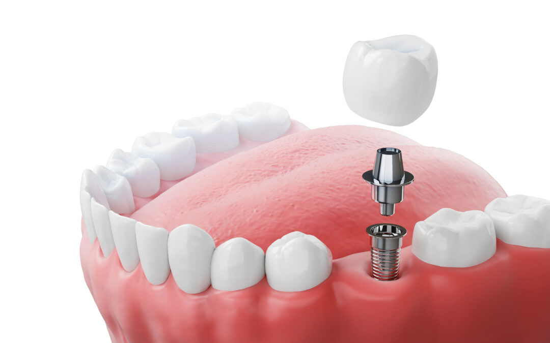 How to Choose the Right Dental Implant Specialist in Your Area