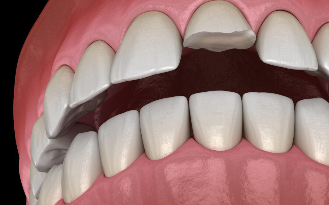 Cracked Teeth in Winter: Causes, Symptoms, and Treatment