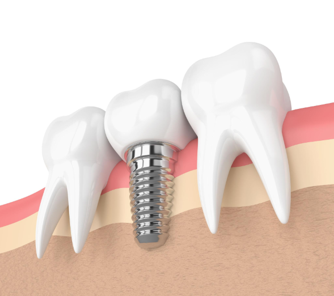 How Does iFinance Work for Major Dental Work and Implants?
